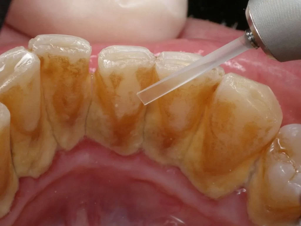 Bağdat Diş Polikliniği’nden Diş Taşı (Tartar) Temizliği: Belirtileri ve Tedavisi